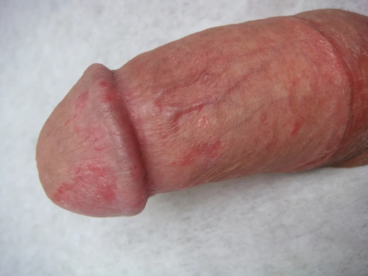 Viêm bao quy đầu: nhận biết sớm, trị dứt điểm
