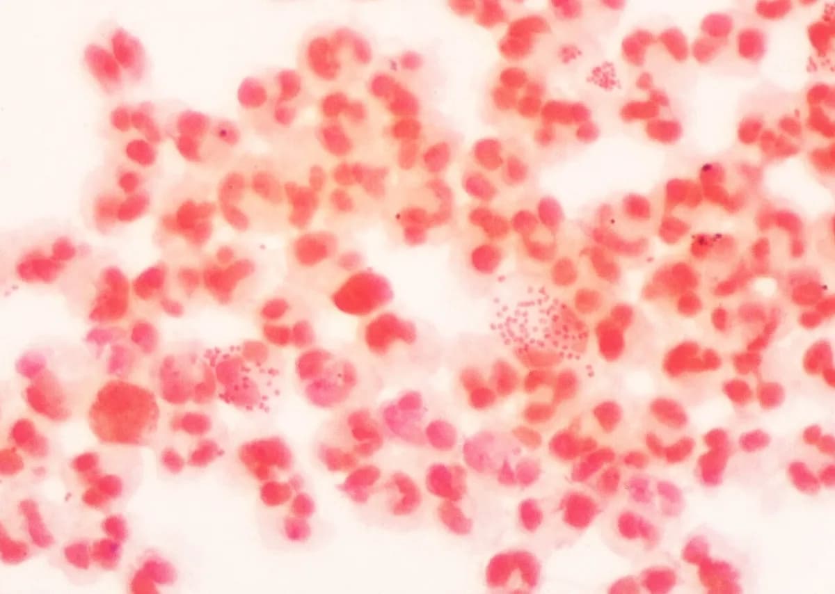 Viêm niệu đạo không do lậu: Chlamydia và những thủ phạm thầm lặng