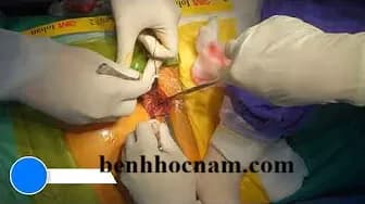 Sỏi thận to, sỏi san hô: tán sỏi qua da hay mổ mở?