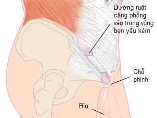 Chuyên gia điều trị thoát vị bẹn tư vấn