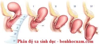 Điều trị sa sinh dục: bàng quang, tử cung bằng nội soi tái tạo dây chằng tròn