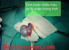 Cấp cứu nhanh nhất cho bệnh nhân được nghi ngờ bị đe dọa hoại tử tinh hoàn