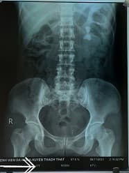 Các kỹ thuật ngoại khoa điều trị sỏi thận không xâm lấn, ít xâm lấn và xâm lấn