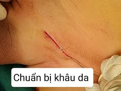 Sau mổ thoát vị bẹn thấy cộm có sao không?