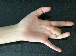 Chẩn đoán bệnh - bất thường cổ bàn tay bằng hình ảnh