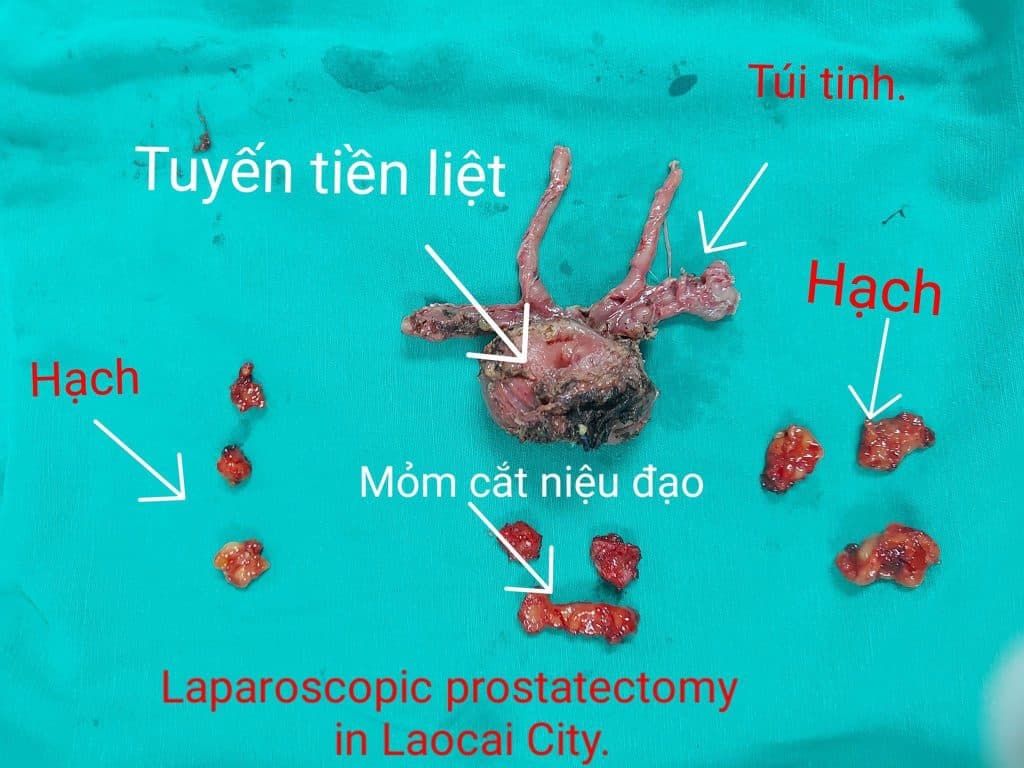 PHẪU THUẬT NỘI SOI NGOÀI PHÚC MẠC CẮT TOÀN BỘ TUYẾN TIỀN LIỆT ĐỐI VỚI UNG THƯ TUYẾN TIỀN LIỆT KHU TRÚ:KINH NGHIỆM BAN ĐẦU TẠI BỆNH VIỆN E