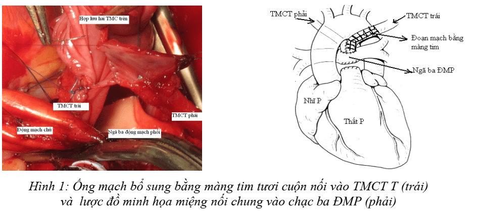 PHẪU THUẬT GLENN HAI HƯỚNG Ở BỆNH NHÂN CÓ HAI TĨNH MẠCH CHỦ TRÊN: CÓ GÌ MỚI VỀ KỸ THUẬT LÀM MIỆNG NỐI?
