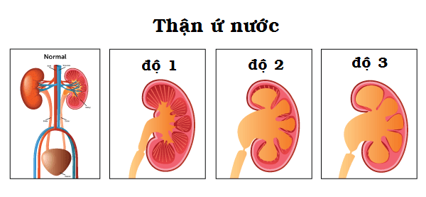 Một số nguy cơ tổn thương chức năng thận và sức khỏe cơ thể do sỏi tiết niệu