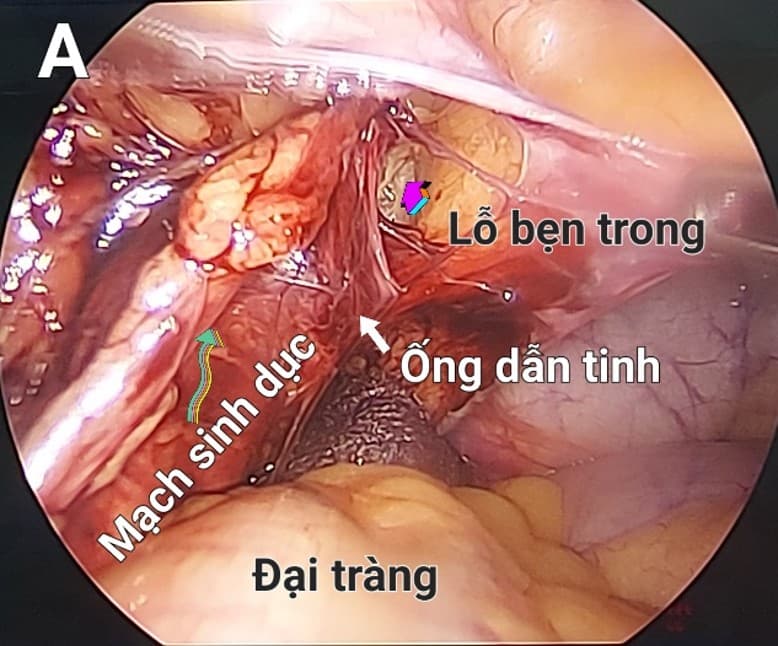 KẾT QUẢ BAN ĐẦU PHẪU THUẬT NỘI SOI HẠ TINH HOÀN Ở BỆNH NHÂN MẮC TINH HOÀN KHÔNG XUỐNG BÌU TÁI PHÁT VÀ THỨ PHÁT