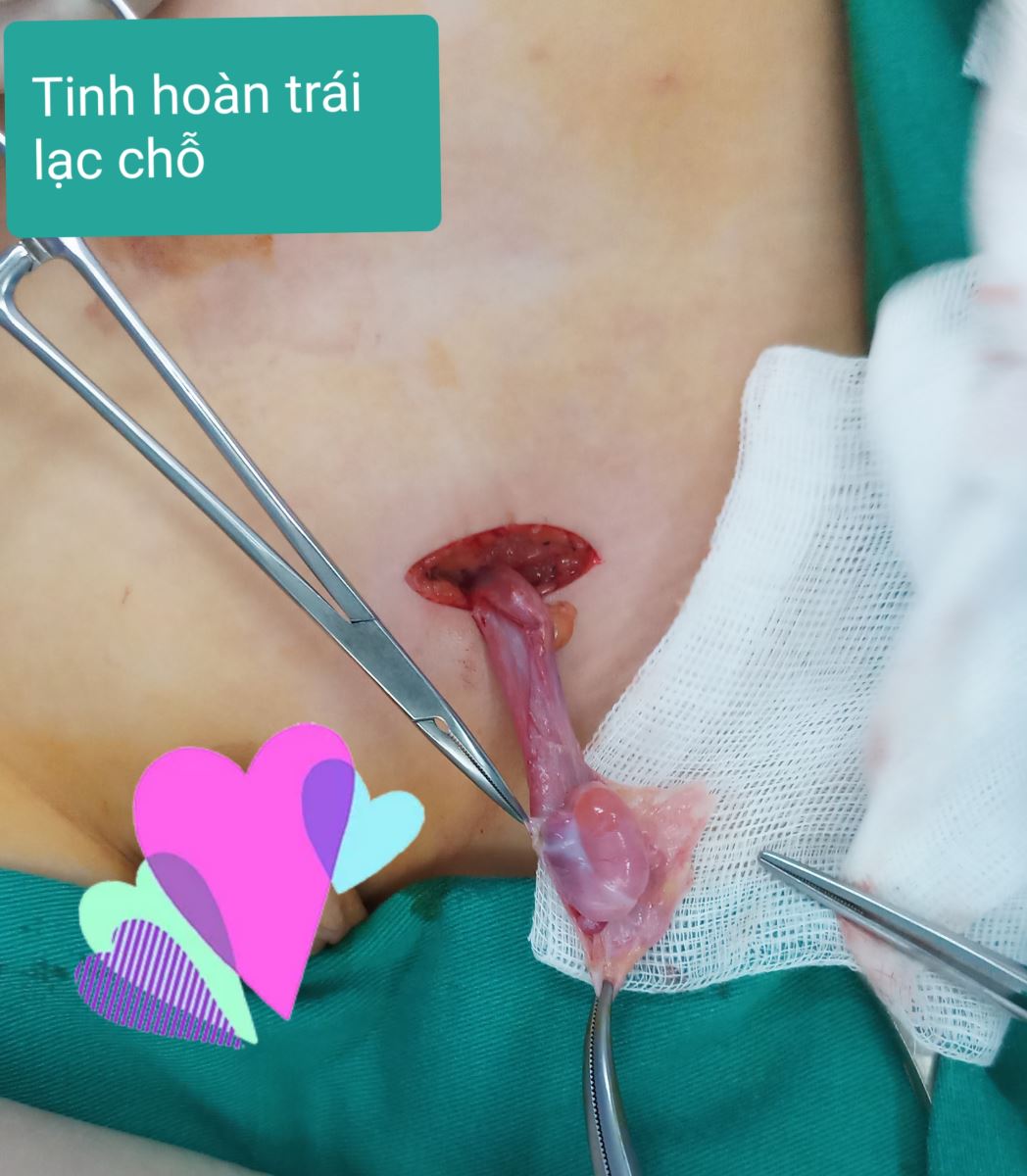 tinh hoàn KS2