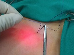 Thay chỉ Vicryl bằng  PDS/benhhocnam.com