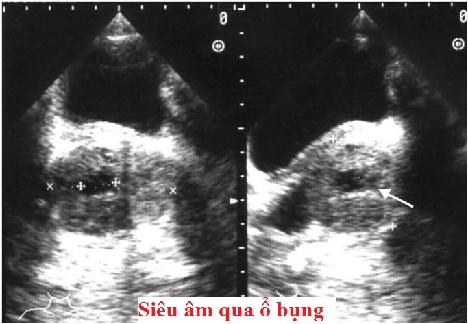 Siêu âm ổ bụng khảo sát TTL