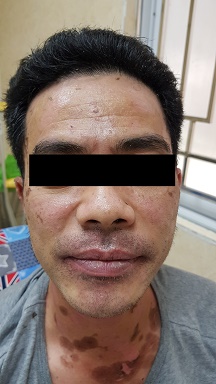 Hoại tử thượng bì - Sau điều trị