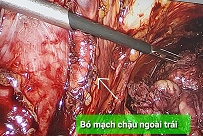 Vét hach chậu/benhhocnam.com