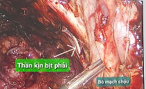 Vét hạch chậu bịt/benhhocnam.com