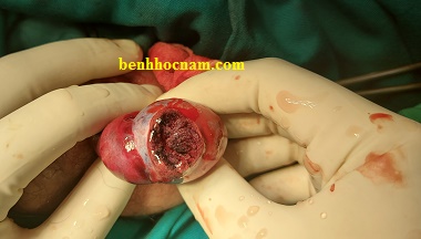 xoắn thừng tinh hoàn 2/benhhocnam.com