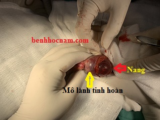 Nang nước tinh hoàn/benhhocnam.com