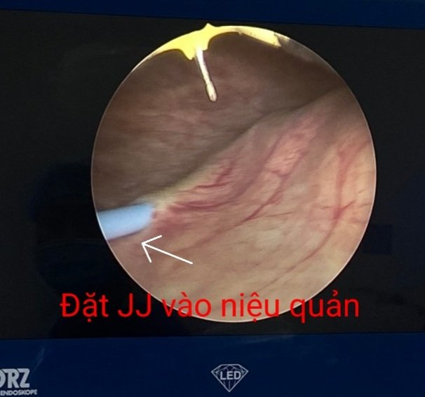 Đặt JJ vào niệu quản/benhhocnam.com