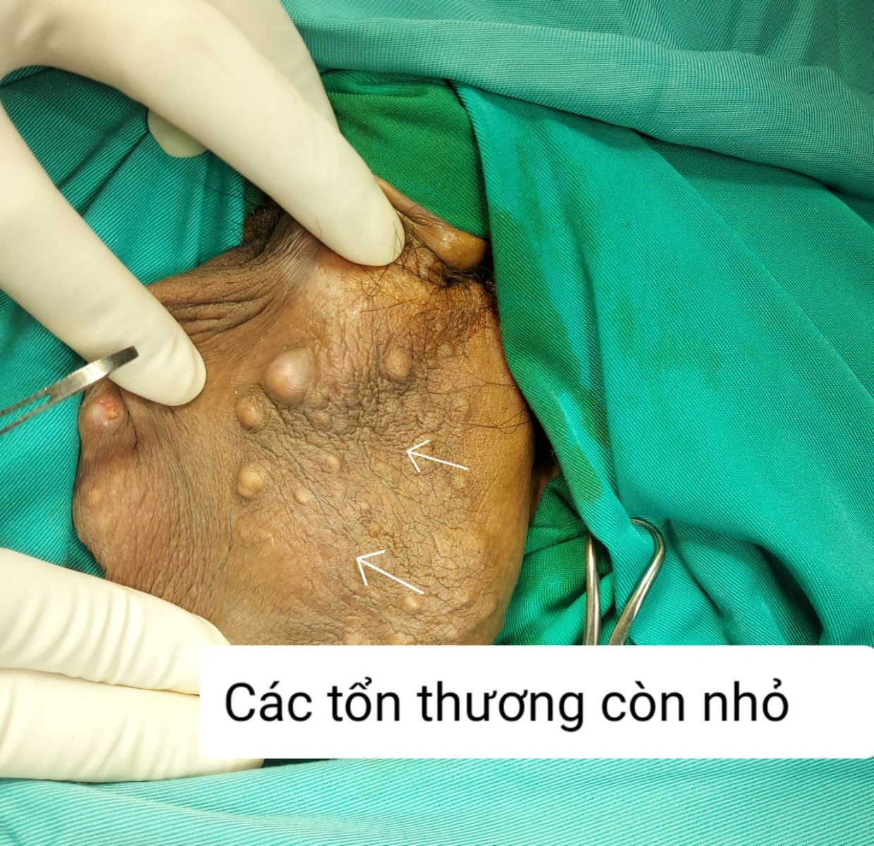 Đa nang tuyến bã/benhhhocnam.com