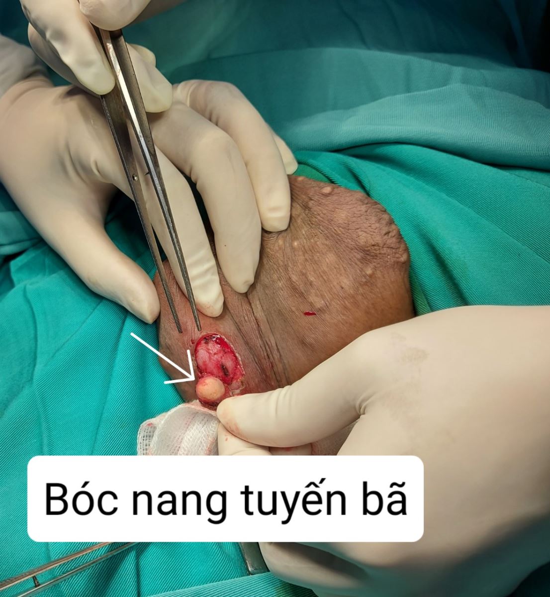 Bóc nang tuyến bã/benhhocnam.com