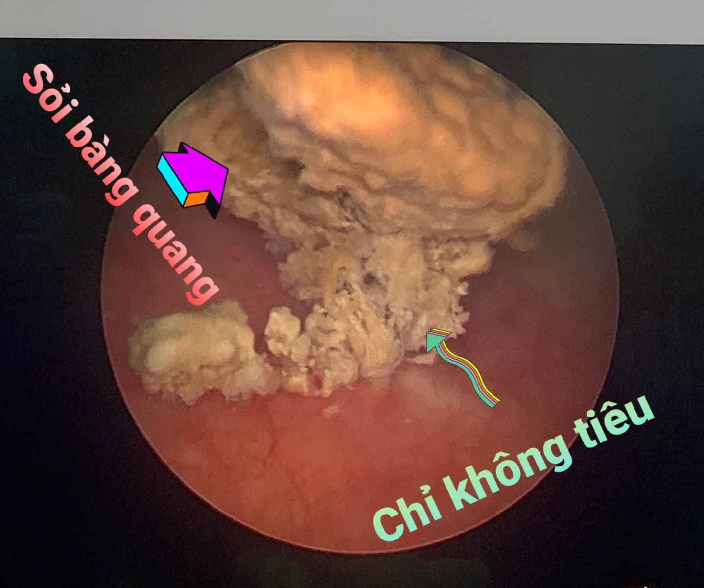 Sỏi bàng quang do chỉ khâu không tiêu/benhhocnam.com