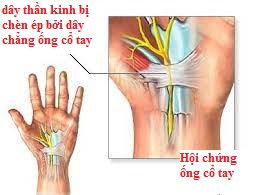 Cơ chế gây ra hội chứng đường hầm cổ tay/benhhocnam.com
