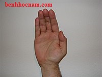 Liệt thần kinh giữa/benhhocnam.com
